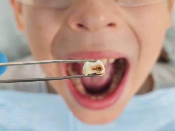 Best Emergency Dental Extractions in Eastport, ME